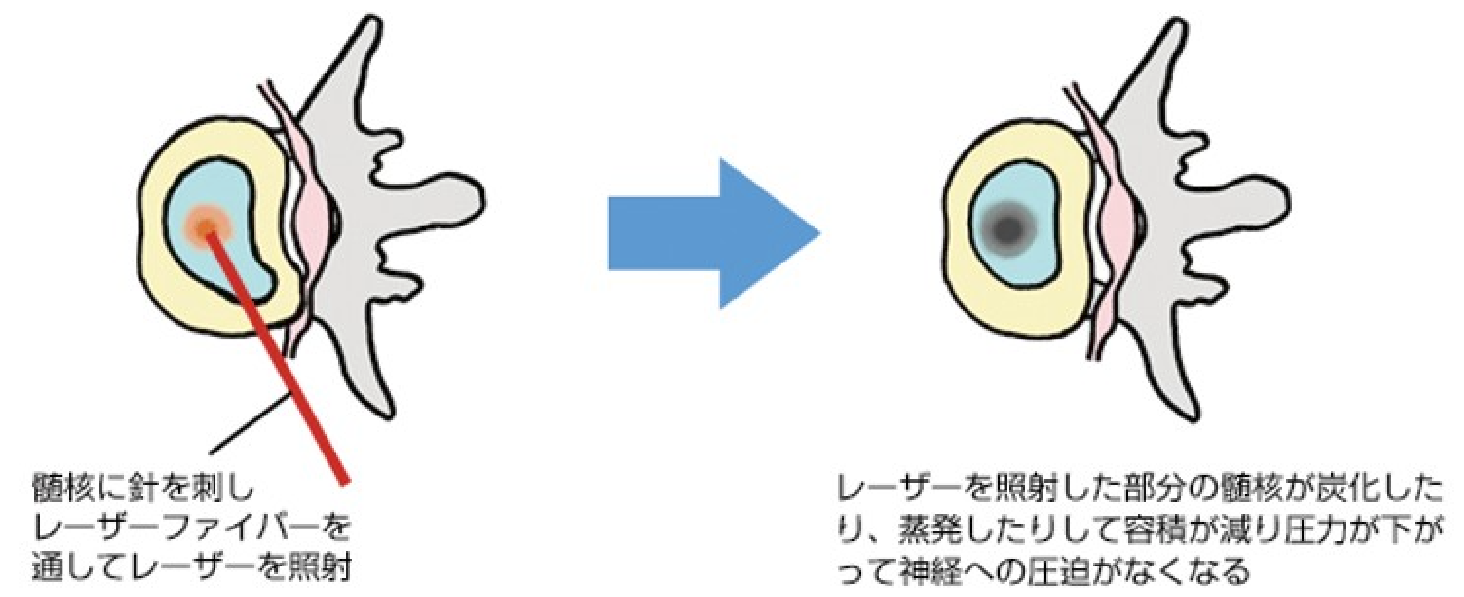 椎間板ヘルニアに対するレーザー治療