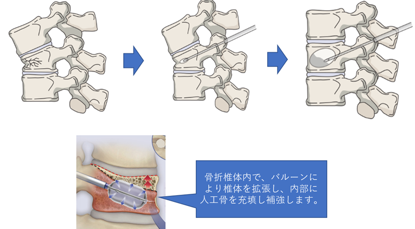 経皮的椎体形成術0425