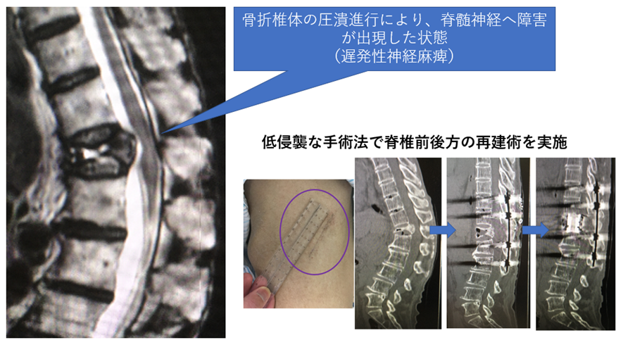 脊椎破裂骨折0425