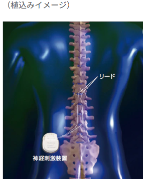 脊髄刺激療法0425